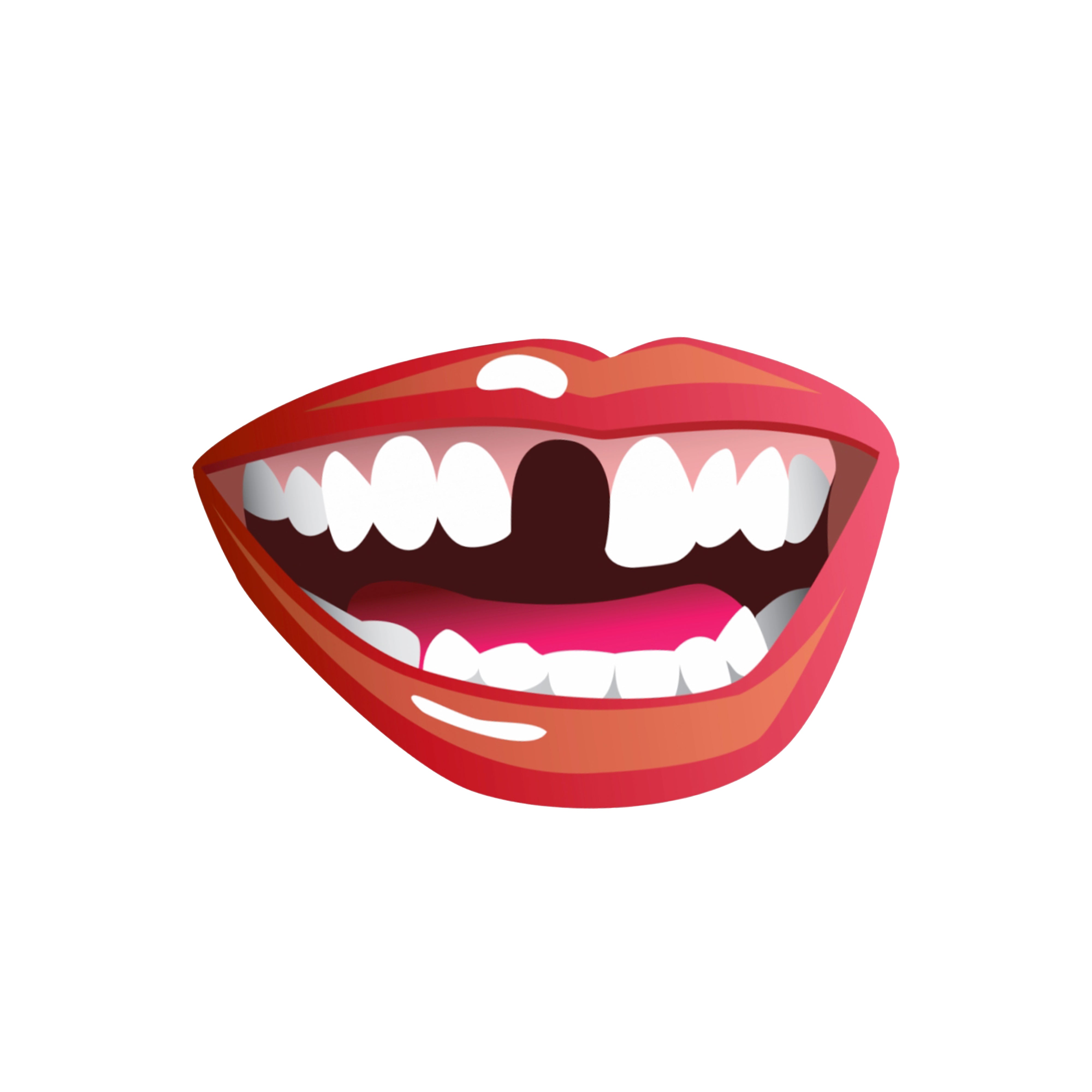 Missing Teeth or Chipped Teeth for Custom Grillz